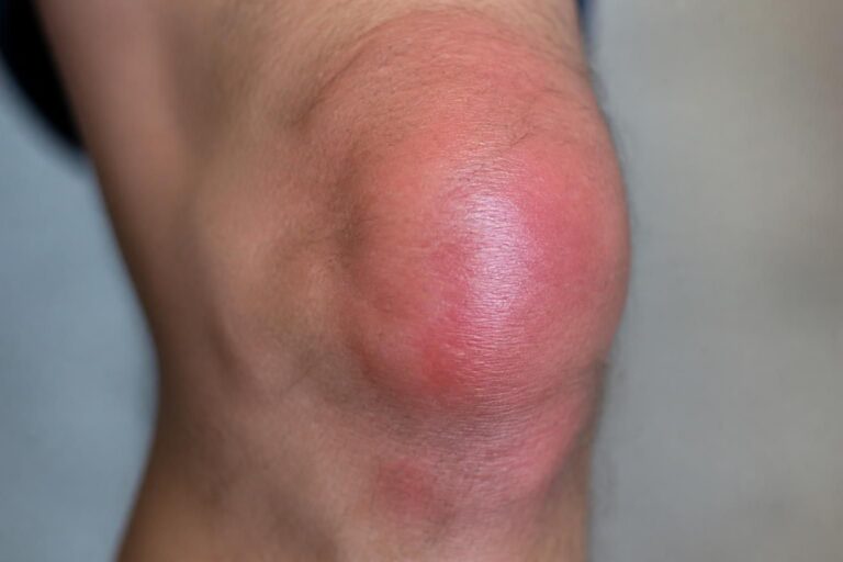 ontdek de oorzaken, symptomen en verschillende behandelingsmogelijkheden voor een ontsteking in de knie. leer hoe je pijn en zwelling effectief kunt aanpakken.